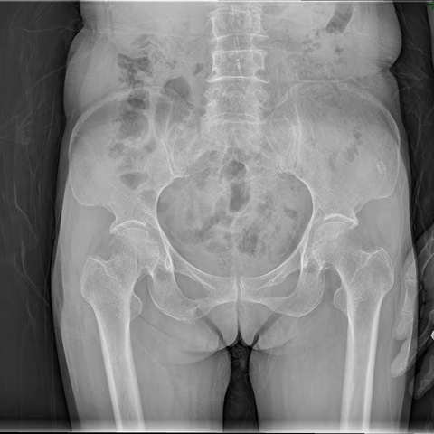 老年人髋部骨折，是选择手术还是选择“躺平”？