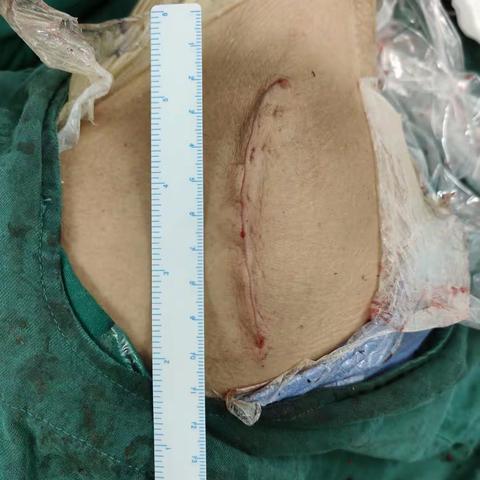 冷知识分享：微创不等于切口长度