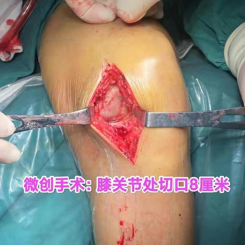 哪里痛就动哪里：微创膝关节单间室置换