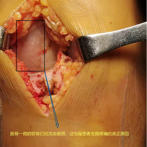 术后患者门诊随访报告：膝关节前内侧骨性关节炎（AMOA）（副本）