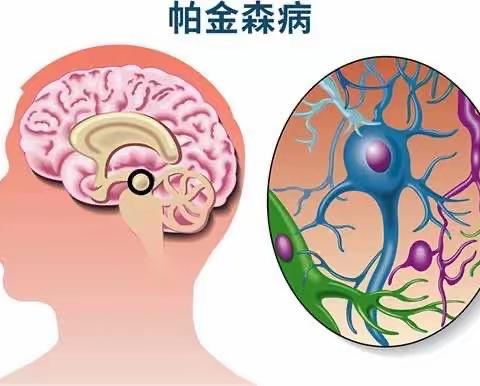 帕金森早期：识别和治疗的关键