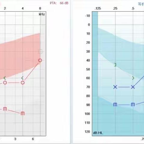 耳鸣烦人难耐，怎么办？听力学精准干预有良方，高效快速消除耳鸣（三）