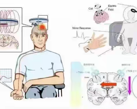 二十一世纪四大脑科学技术之一：经颅磁刺激（陇南市武都区中医医院）