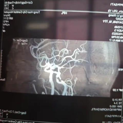 2023-11-27支架   杨力祥  椎基底动脉狭窄
