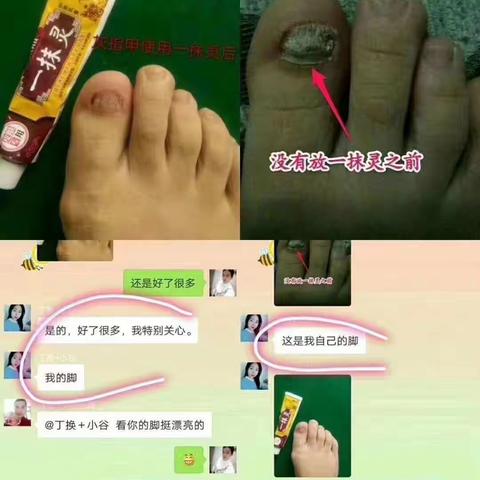 灰指甲为什么不能自愈？