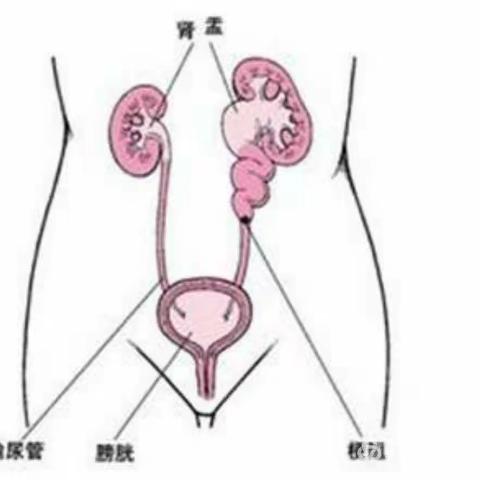 泌尿外科—结石