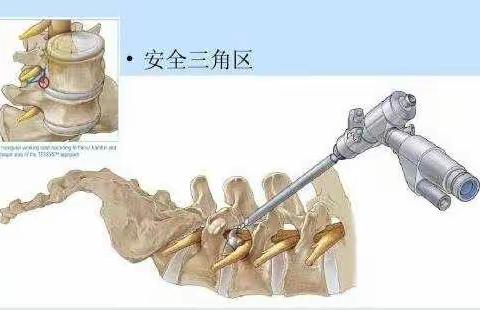 榆次区人民医院骨二科成功独立开展腰椎间盘突出症椎间孔镜下微创手术