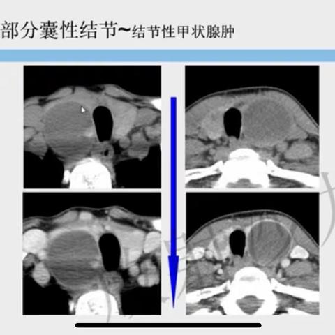 甲状腺囊性病变的CT诊断