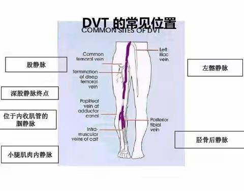 妇科二区VTE健康宣教资料