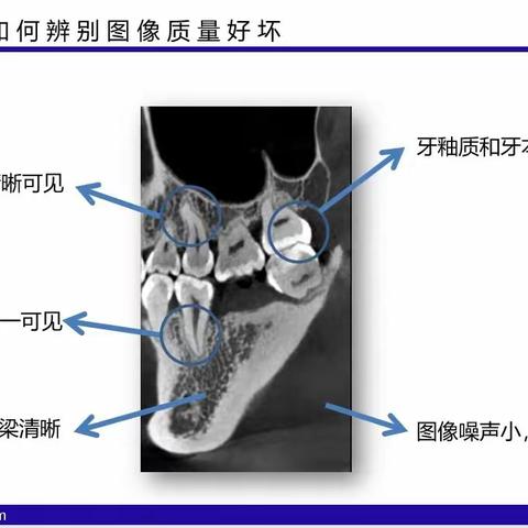 慧眼识珠---如何判断口腔CT清晰度