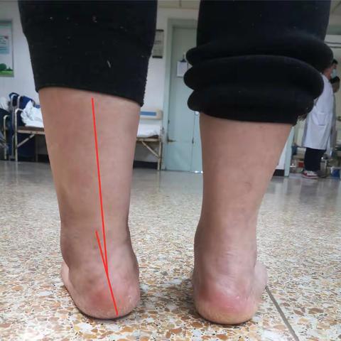 踝关节扭伤，一个值得重视的损伤