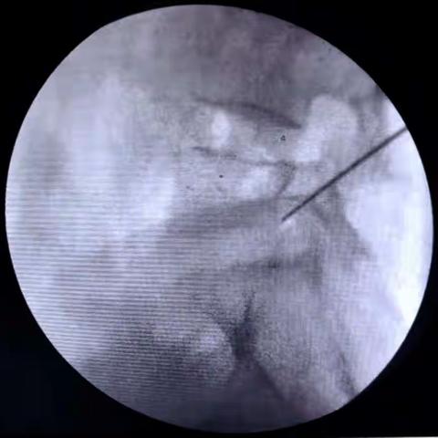 临川区第一人民医院开展椎间孔镜技术基础