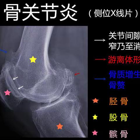 骨关节炎健康指导