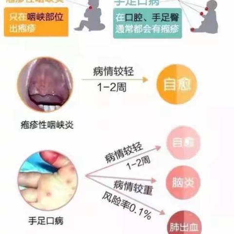 预防幼儿常见的传染病，疱疹性咽峡炎和手足口病