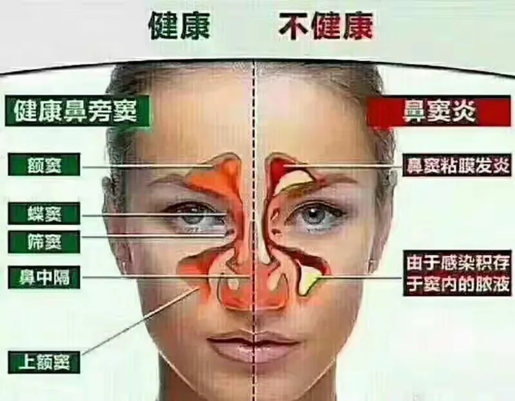 【嚊本堂】鼻炎、鼻窦炎?看这里教你养护!