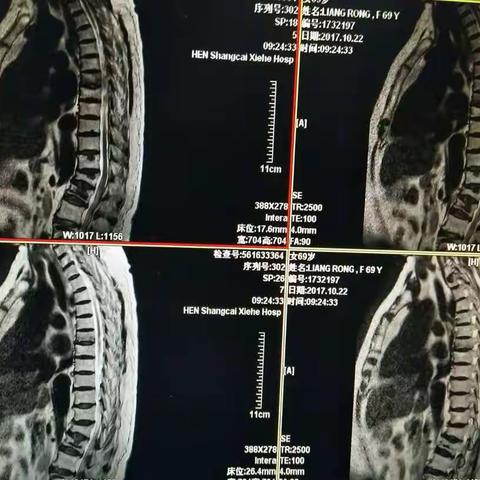 老年骨质疏松骨折椎体成型术