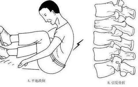 腰椎压缩性骨折坚持急诊治疗