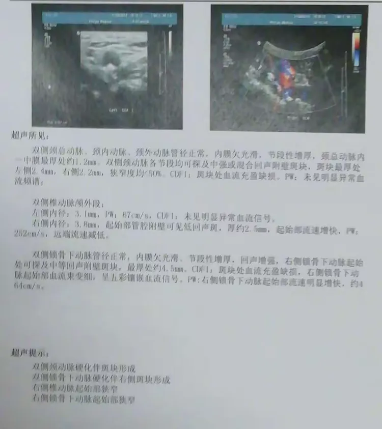 甲状腺彩超检查结果