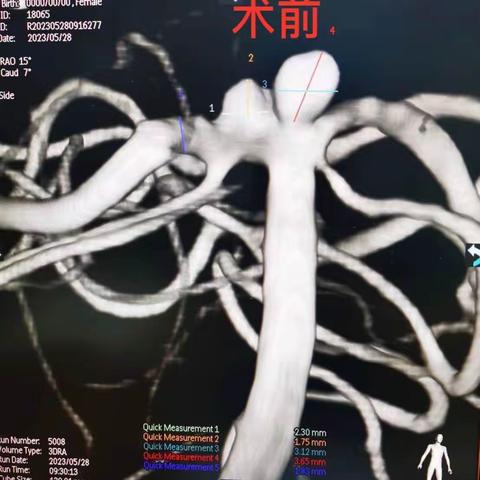 六一儿童节，全世界关注少年儿童，人民医院脑卒中防治中心神经外科团队关注你的健康！