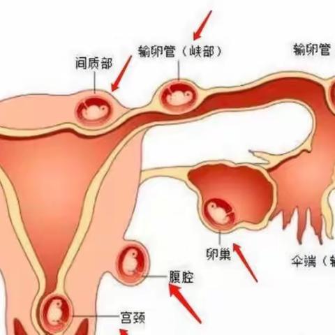 妇科成功抢救一例宫颈妊娠大出血病例