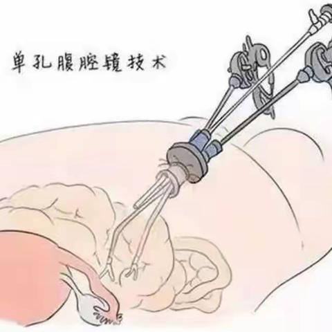 妇科单孔腹腔镜下巨大子宫肌瘤剔除术一病例分享