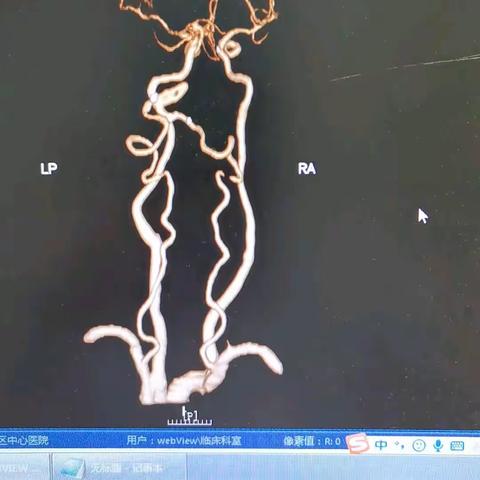 临床判断准确，路径却浪费时间+后记2再次闭塞开通