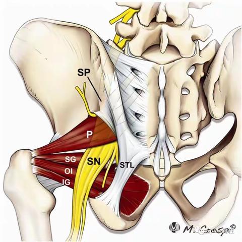 3分钟Get：梨状肌综合征的诊断和治疗！