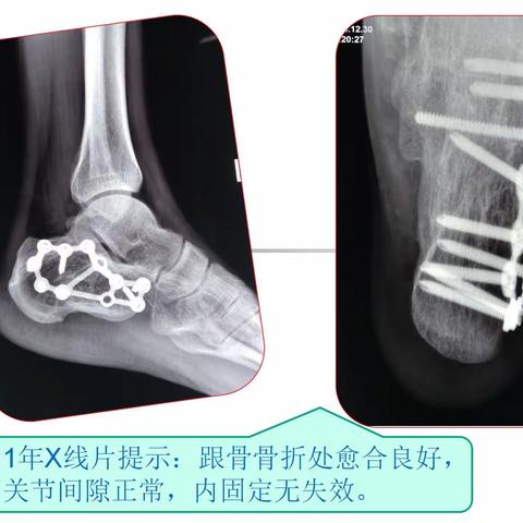 【足踝篇】 跟骨骨折的治疗（病例展示）