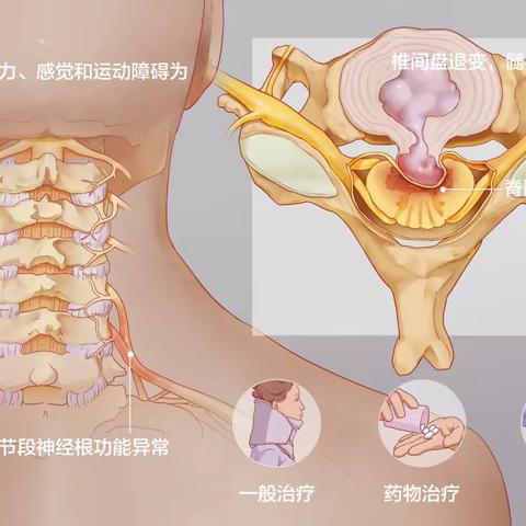 脊髓型颈椎病和脑梗“脚踩棉花”感觉有哪些不同？