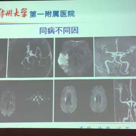 脑心健康管理师培训———缺血性脑血管病病因分型           脑心健康管理师第十六组学员张伟伟、孔宝娟、张亚玲