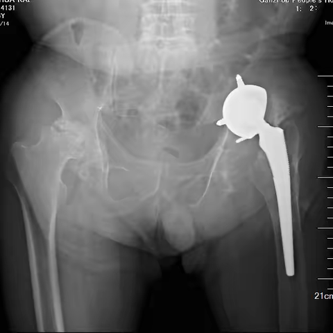 关节外科成功为一位人工髋关节置换术后感染患者行翻修手术
