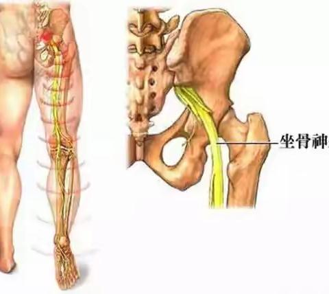 战胜腰椎间盘突出症，什么事情最关键？