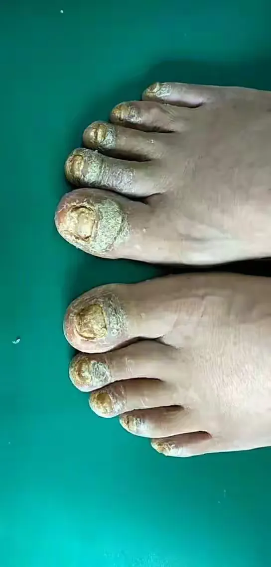 【什么叫灰指甲】灰指甲是什么原因引起的？？？