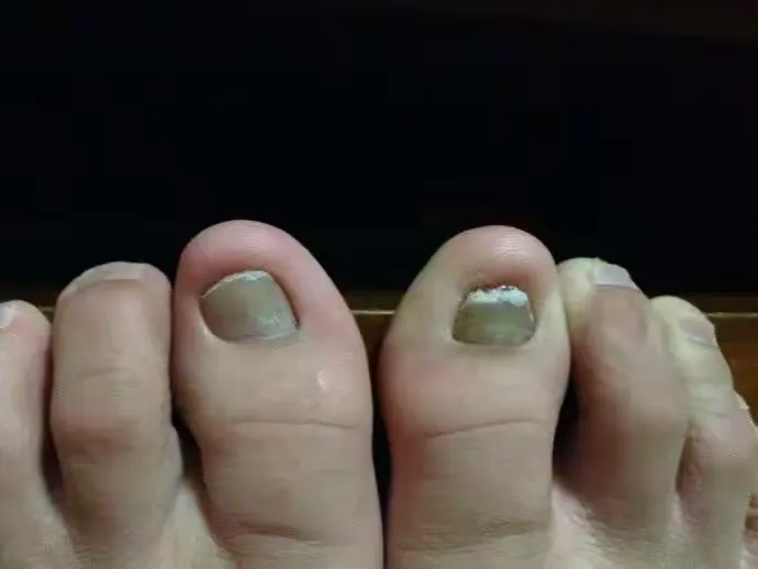 【什么叫灰指甲】灰指甲是什么原因引起的？？？
