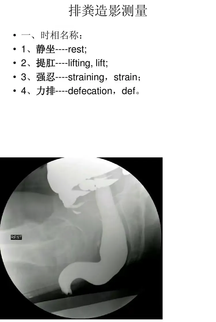 排粪造影及测量