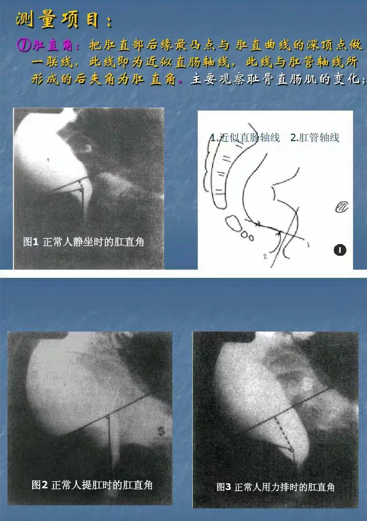 排粪造影及测量