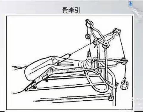 骨科病人的一般护理