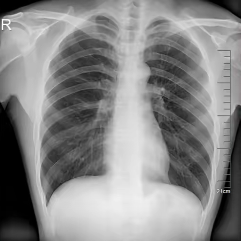 你的心简读X线中的心影