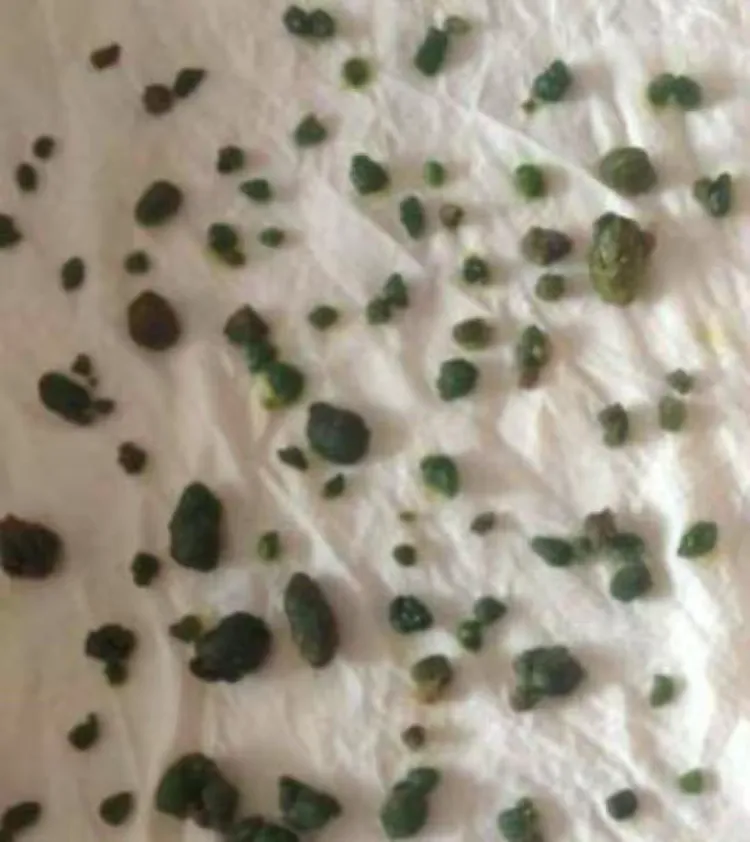 秋冬排毒从肝脏胆管排结石开始【促销活动】