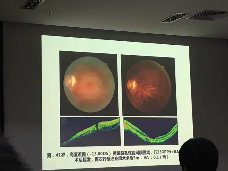 高度近视黄斑病变的治疗