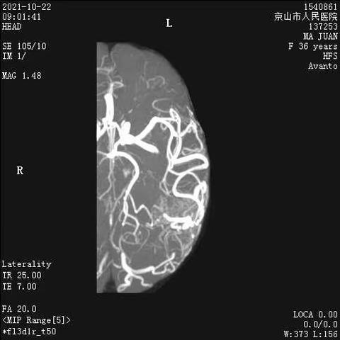 一例大脑中动脉供血脑动静脉畸形的栓塞治疗