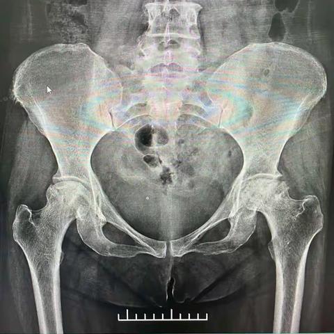 一例肥胖患者双髋关节置换术在骨一科成功实施