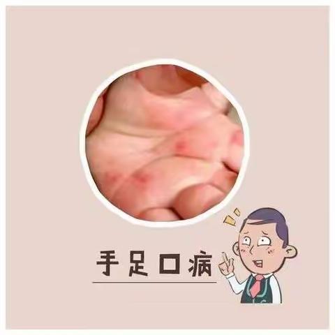 新世纪幼儿园——手足口病预防告家长书