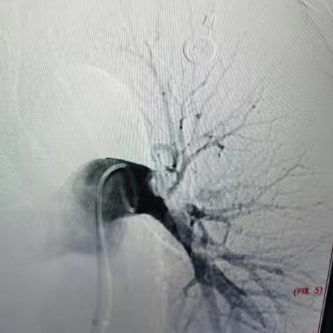下肢静脉血栓引起肺动脉栓塞后介入治疗