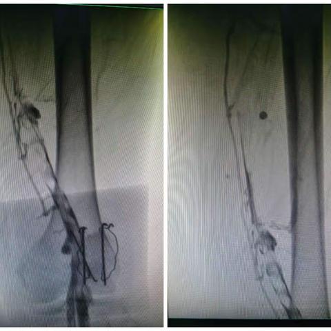 下肢静脉血栓介入治疗
