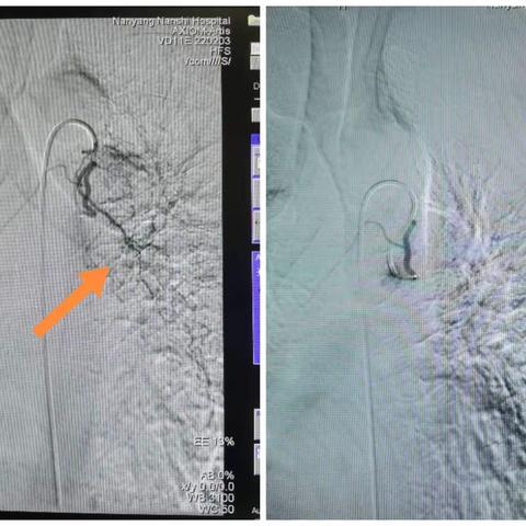 肺癌咯血介入治疗