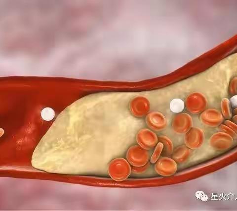 血管疾病找介入
