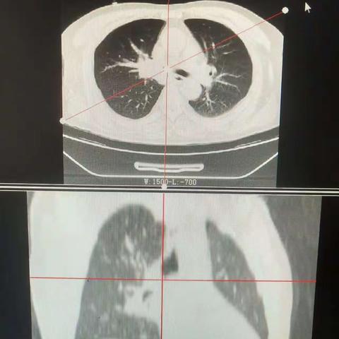 气管狭窄的救命稻草