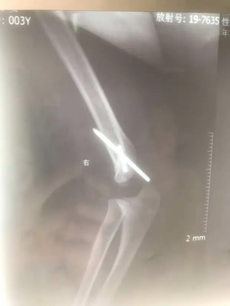 一例儿童右肱骨外髁骨折病例