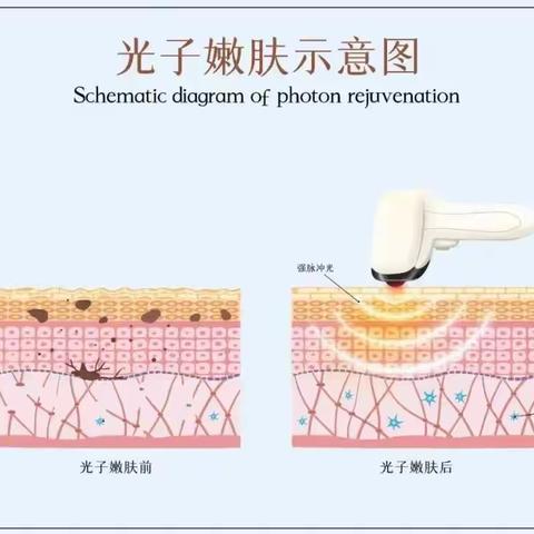 哪些人适合做光子嫩肤丨科普篇